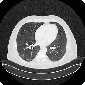 CT vom Thorax