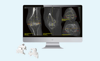 Knieprothese mit 3-D-Technik