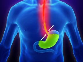 Refluxösophagitis