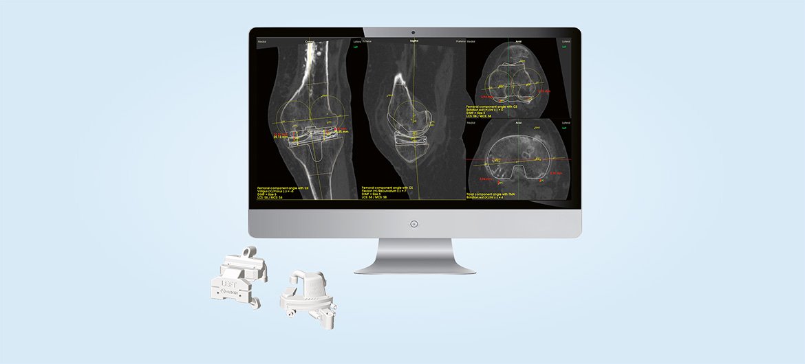 Individuell gefertigte Knieendoprothese mittels 3-D-Technik